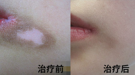 清明小长假,2022春季白斑抗复发诊疗援助活动开启!