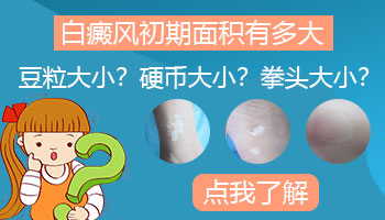 从发现白癜风开始算多长时间算初期