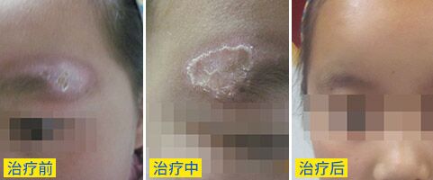 邢台白癜风治疗ZUI好方法