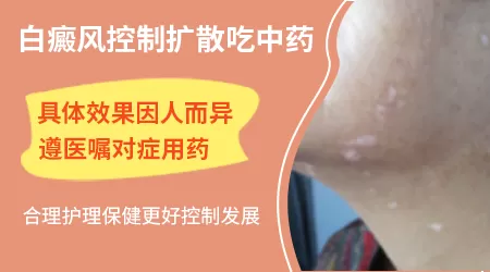 白癜风吃中药还长新的白斑怎么办