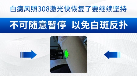 6岁孩子面部白癜风能不能照308准分子激光