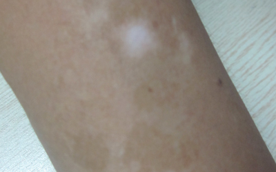 孩子胳膊上有块白斑腿上也有白斑怎么回事