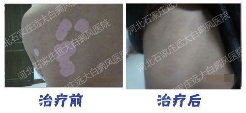 邢台市能治疗白斑吗 邢台白癜风医院怎么样