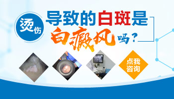 烫伤发白与白癜风怎么区别