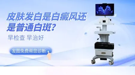 孩子脸上长淡白斑是白癜风吗