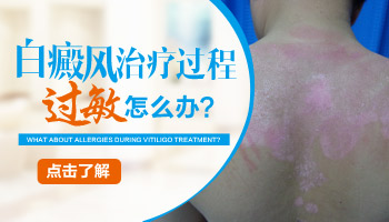白癜风用药过敏怎么办