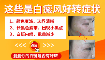 儿童额头白癜风好转迹象