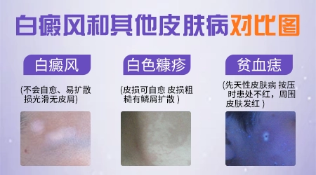 不同的白斑刚开始有什么症状图片