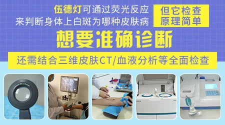 伍德灯照出来的荧光就是确诊白癜风的依据吗