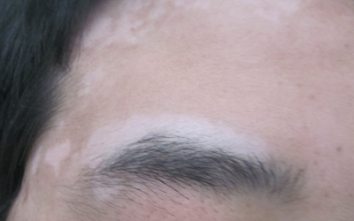 眉毛长白斑初期症状图片