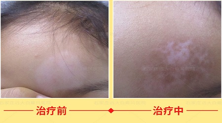 白癜风恢复期图片长什么样
