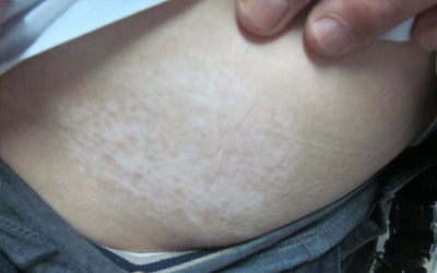 宝宝屁股有一块皮肤泛白