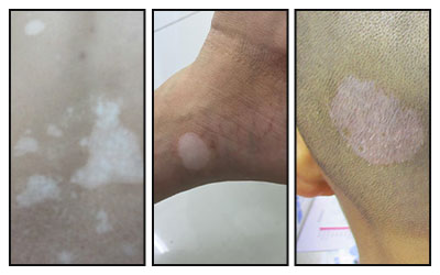 女孩散发型白癜风怎么治