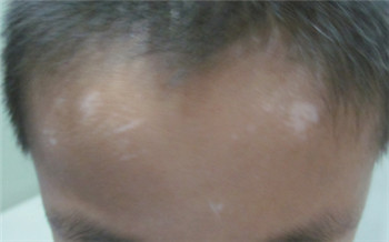 头上要是长了白癜风会是什么样子