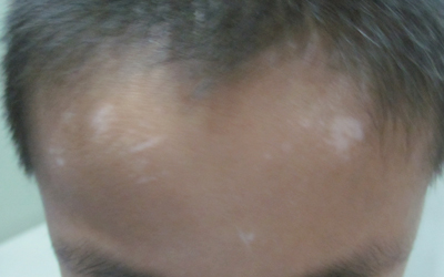 十三岁男孩额头发际线皮肤发白怎么回事