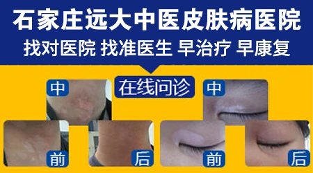 邢台哪家医院治疗白癜风口碑好