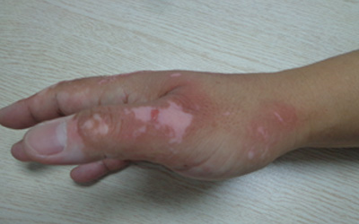 手部白癜风初期症状图片