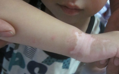 孩子皮肤瘙痒抓破皮后皮肤变白怎么回事