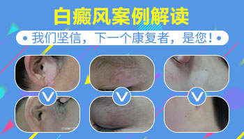 治疗白癜风民间偏方哪个好