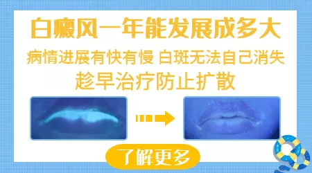 白癜风什么情况下只抹药不用照光