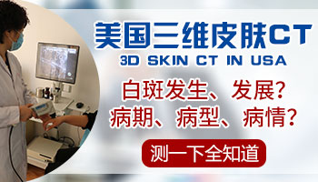 白癜风有急性发作期吗