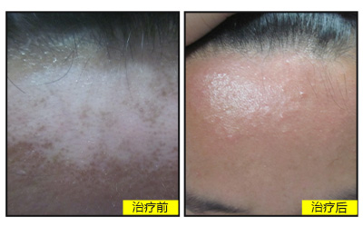 额头上的白癜风一个月了有轻微扩散怎么办