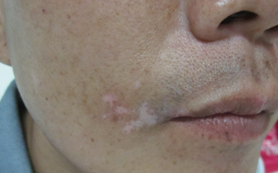 初期嘴角白斑图片是什么样的