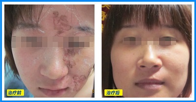 白癜风表皮移植后的恢复图