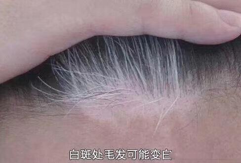 如何判断额头的白发是不是白癜风引起的
