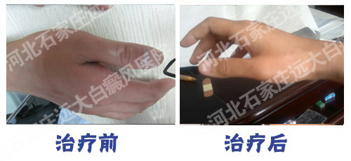 手上白块 有白块是什么是不是白癜风