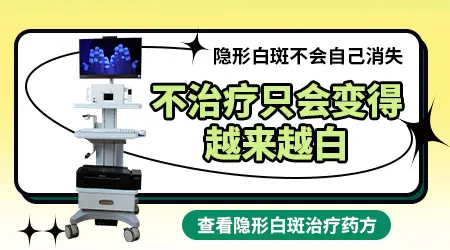 伍德灯检查出的隐性白斑怎么治好