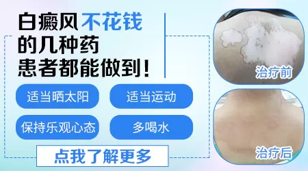 中医治疗皮肤白斑案例