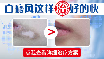 白癜风疾病这样治 白斑恢复更快