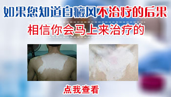 白癜风不及时治疗有什么后果