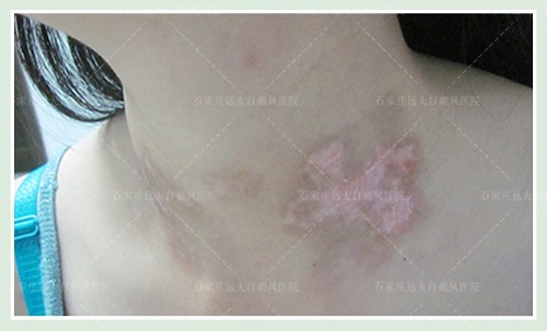 脖子突然有一块儿皮肤发白是什么