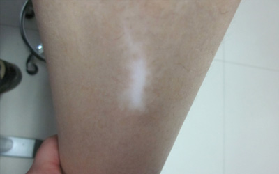 17岁男生皮肤白斑 长白斑是因为什么