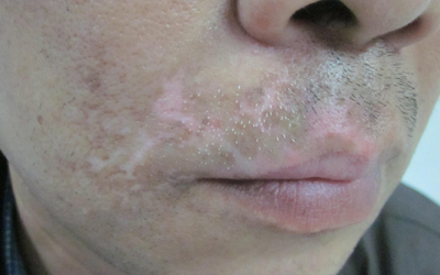 嘴唇白斑肉眼分辨不了是不是白癜风怎么办