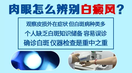 辨别白癜风的方法