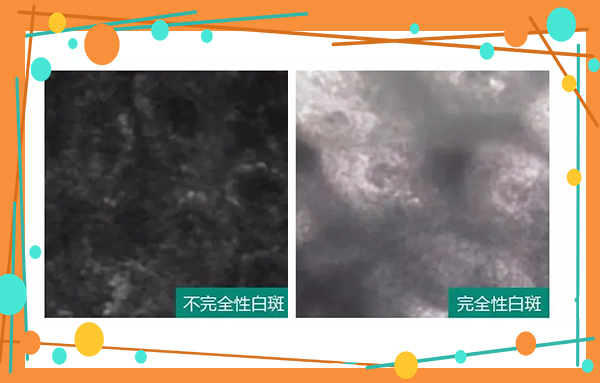 6.25世界白癜风日—“拒绝歧视,共抗白斑”普查援助活动