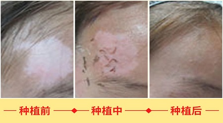 什么样的白癜风适合种植黑色素