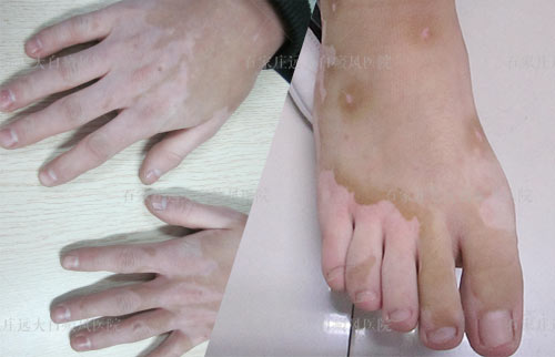 手脚白治疗白癜风科诺的多少钱
