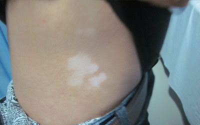 身上出现的白斑是不是白癜风