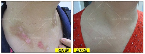 311适合什么类型的白癜风