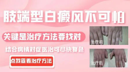 膝盖处的白癜风好的慢吗