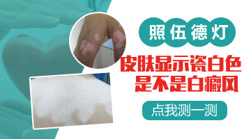 伍德灯显示白斑部位已经接近瓷白色