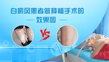手术治疗白癜风恢复速度快吗