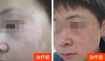 白癜风面部植皮手术图