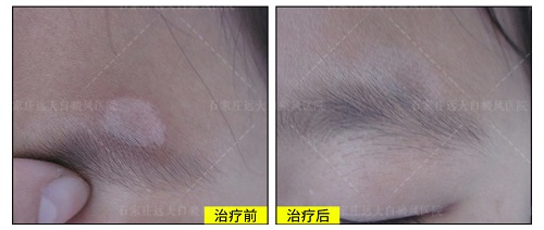 不同阶段的白癜风治疗应该怎么区分开