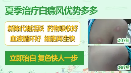 夏季出汗多会不会影响白癜风治疗