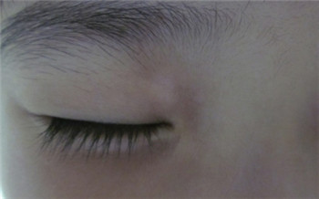 孩子眼睛周围皮肤一圈发白了怎么回事